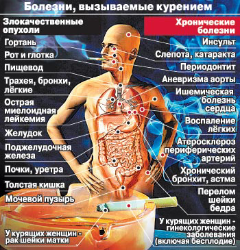 Болезни вызываемые курением