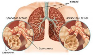 Бронхит курильщика