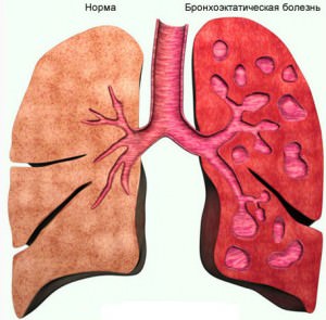 Бронхоэктатическая болезнь