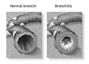 Бронхит