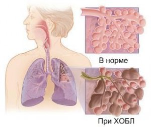 Хроническая обструктивная болезнь легких (ХОБЛ)