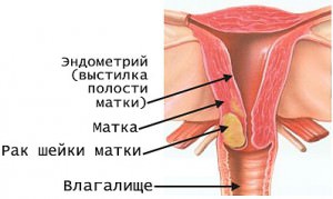 Рак матки