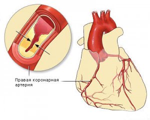 Коронарный тромбоз