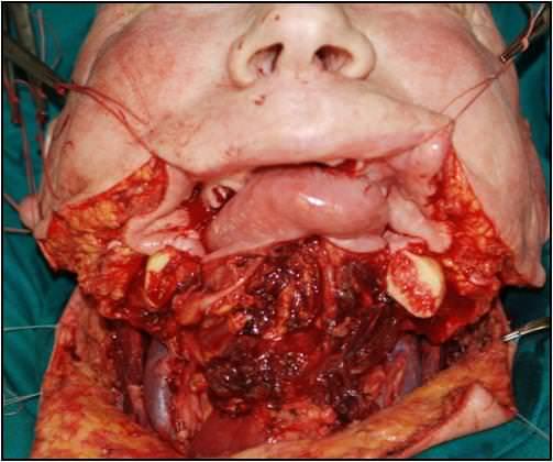 Операционная рана после удаления рака ротовой полости